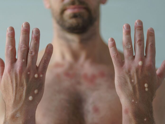 Boosting Immunity and Recovery with Monkeypox Natural Health Diet.