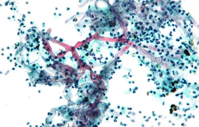 Mucormycosis, often called black fungus, is a severe fungal infection that can affect various organs in the body, including the brain, lungs, and sinuses.